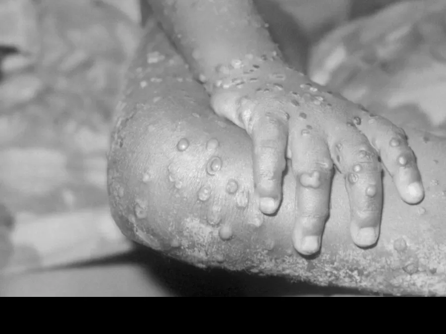 مدار الساعة,أخبار خفيفة ومنوعة,جدري القردة,منظمة الصحة العالمية