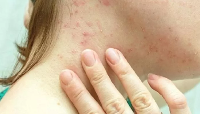 مدار الساعة,أخبار عربية ودولية,وزير الصحة,جدري القردة,وزارة الصحة,منظمة الصحة العالمية