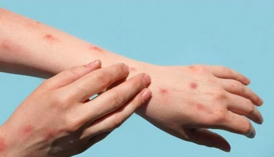 مدار الساعة,أخبار عربية ودولية,جدري القردة,منظمة الصحة العالمية,#جدري_إم_بوكس #الصحة_العالمية #الطوارئ_الصحية