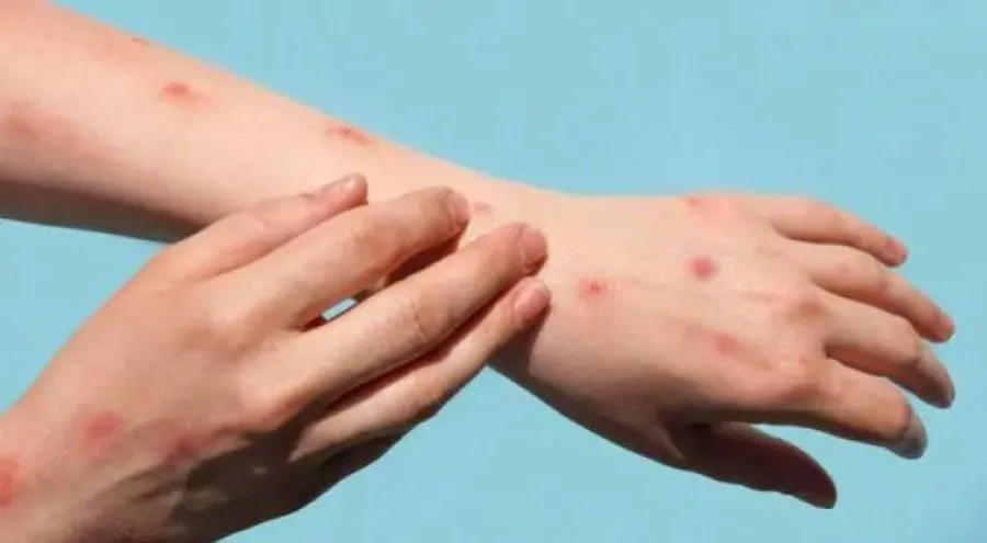 مدار الساعة,أخبار الأردن,اخبار الاردن,جدري القردة,المركز الوطني لمكافحة الأوبئة,منظمة الصحة العالمية