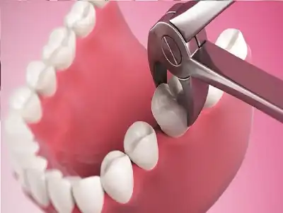 هل على السن دية؟