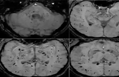 تحليل بالرنين المغناطيسي يكشف تأثير كوفيد-19