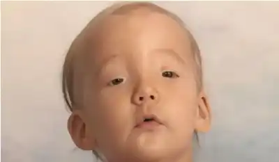 ولدت بلا عضلة للرمش.. شابة من