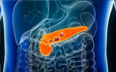 الذكاء الاصطناعي يقتحم علاج سرطان البنكرياس