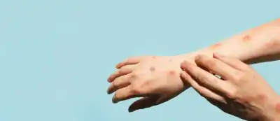 إدراج الجدري المائي ضمن برنامج التطعيم