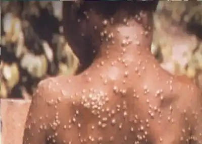 شبح أم بوكس ينهش أنغولا: الفيروس