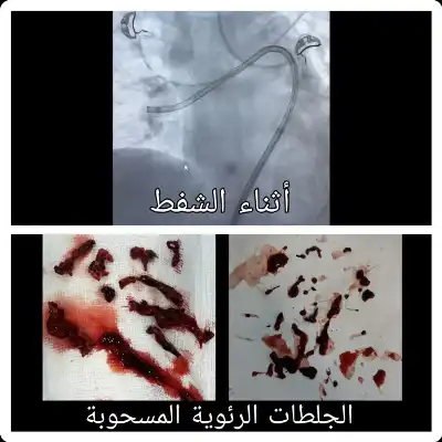 لأول مرة في الأردن.. علاج الجلطة